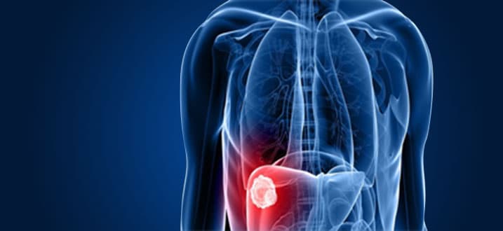 header-hepatobiliary-cancer