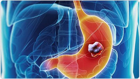 oesophagus-and-stomach-cancer