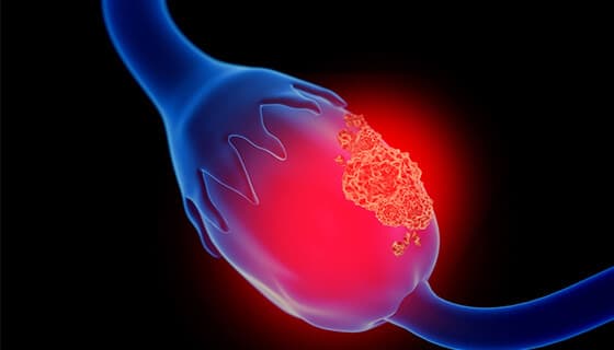 ovarian-cancer